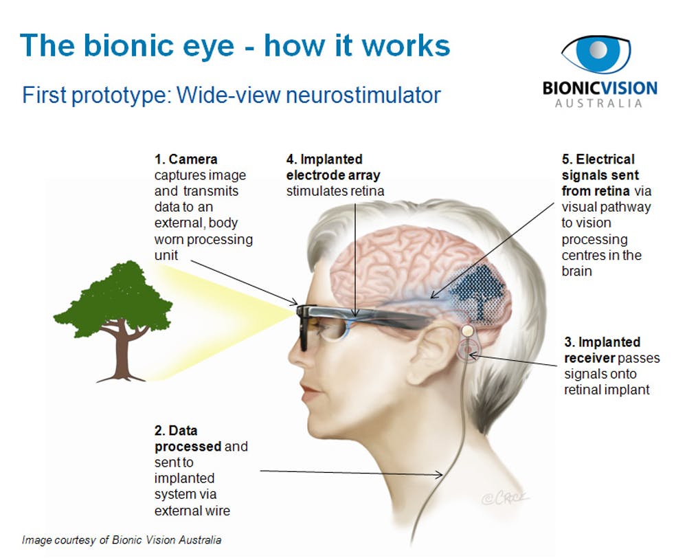 Ever Heard Of The Bionic Eye And The Amazing Technology Behind It